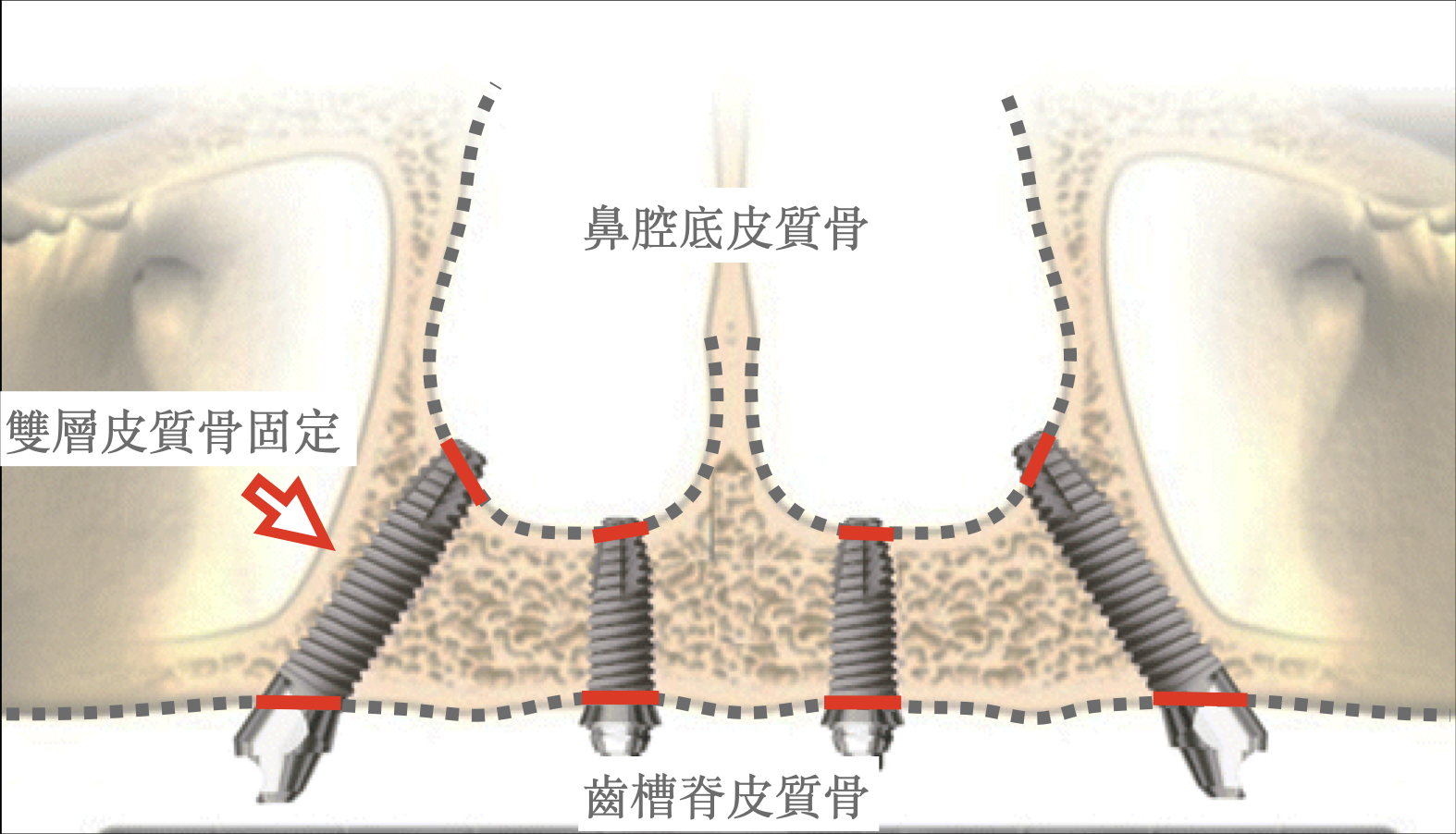 雙層皮質骨固定（Bicortical Fixation）3D 解剖示意圖