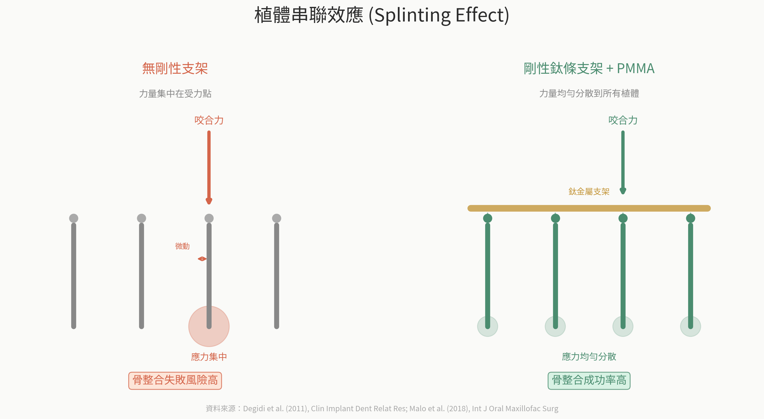 植體串聯效應示意圖——無剛性支架時應力集中導致骨整合失敗 vs 有剛性鈦條支架時應力均勻分散提高成功率